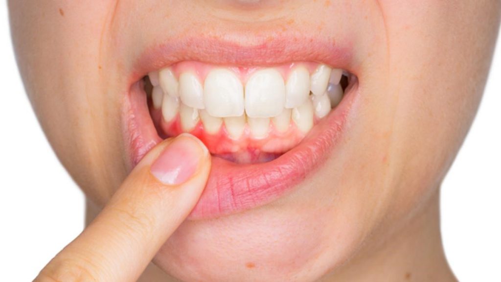 Bệnh viêm nướu răng là gì?