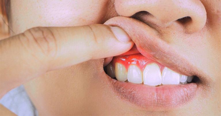Bệnh viêm nướu răng là gì?