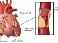 Dấu hiệu bệnh tim mạch ở nữ giới hay gặp