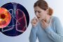 TOP 10 dấu hiệu ung thư phổi biết sớm chữa sớm